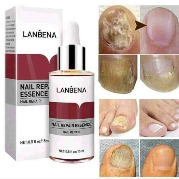 Lanbena Antifongique